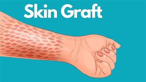 Skin Graft Healing And After Care | Skin grafting, Hand therapy, Skin