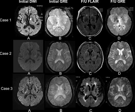 Ischemic Vs Hemorrhagic Stroke Mri