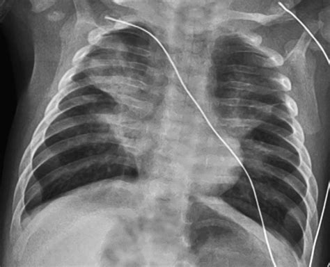 Acute focal pneumonia caused by human metapneumovirus in a 3-month-old ...