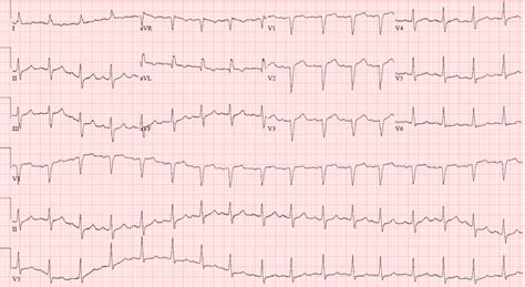 Case 1: An 82-Year-Old-Woman with Crescendo Angina - ECG Made Simple