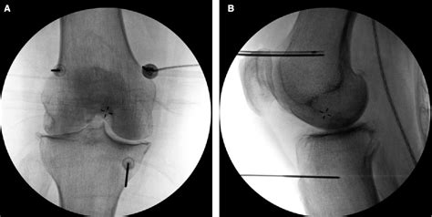 Figure 2 from Cooled Radiofrequency Ablation of the Genicular Nerves for Chronic Pain due to ...