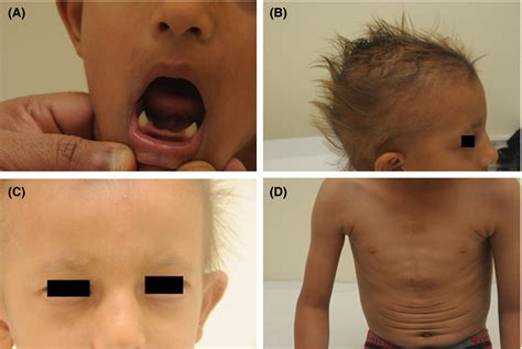 Ectodermal Dysplasia