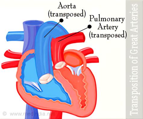 javni prilog Alevacija congenital heart defect transposition of the great arteries Exert ...