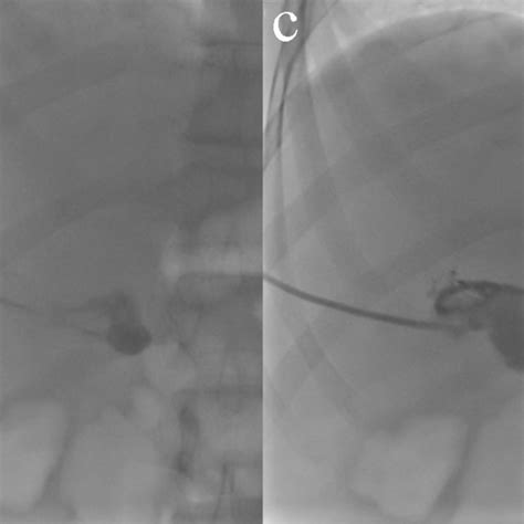 The procedure of percutaneous cholecystostomy. a A 59-year-old man was... | Download Scientific ...