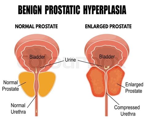 Benign prostatic hyperplasia, vector ... | Stock vector | Colourbox