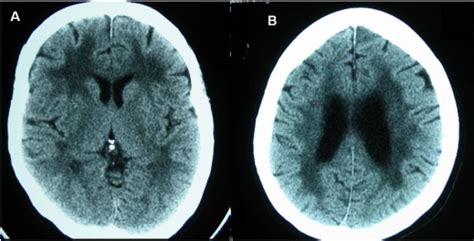 Plain CT brain at the basal ganglia (A) and corona radiata (B) levels ...