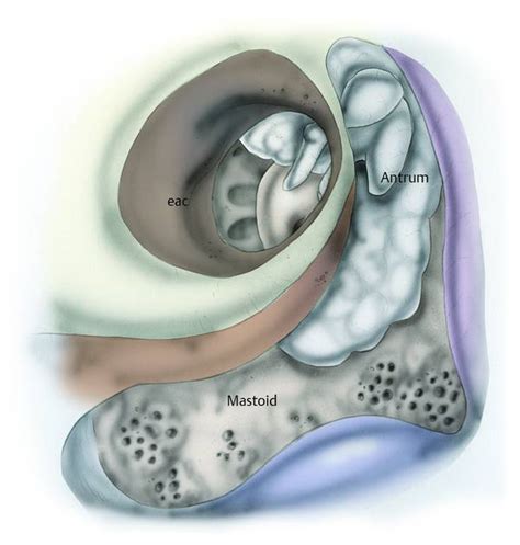 Middle Ear Cholesteatoma Surgery