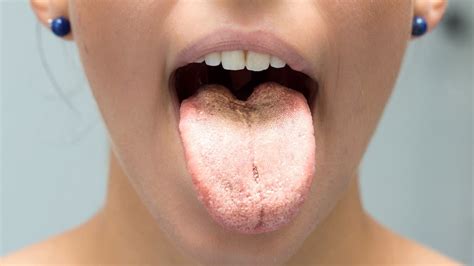 What Does The Color Of Your Tongue Reveal About Your Health?