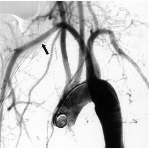 (PDF) Surgical Approaches to the Aberrant Right Subclavian Artery