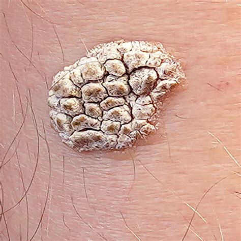 Seborrhoeic keratoses | Spot Check: skin cancer + aesthetics. Melbourne CBD