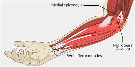 Suffering from Golfer's Elbow, are you? Then, Physiotherapy is your New Buddy! - Care2Cure ...