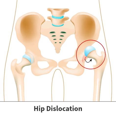 Hip Dislocation Information | Florida Orthopaedic Institute