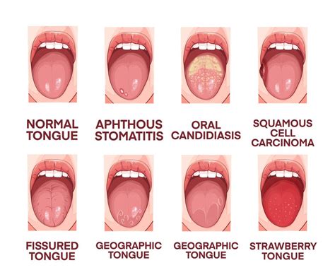 Geographic Tongue