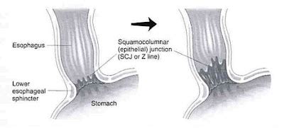 Doctors Gates: Barrett's esophagus