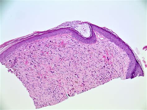 Fibrous Papule Histology