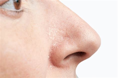 Psoriasis on the Nose: Causes, Treatment, Prevention