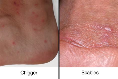 Chigger Bites vs. Scabies: How to Tell the Difference | The Healthy