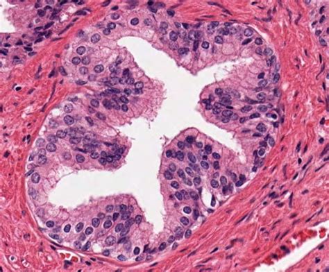 Pathology Outlines - Low grade PIN