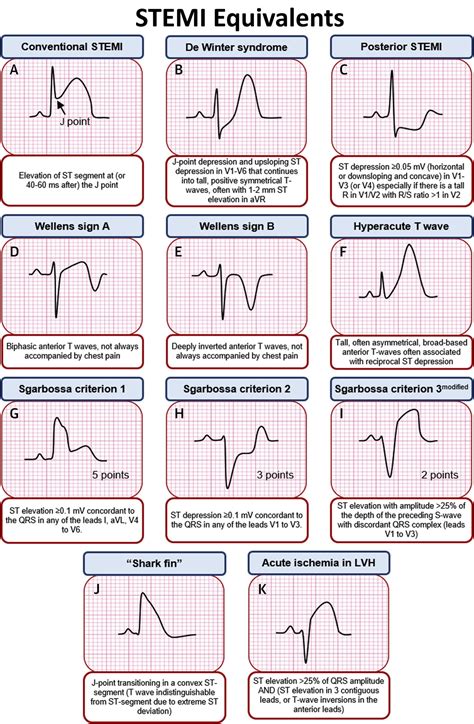 STEMI EKG Map