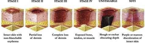 How to keep patients un-HAPI: Cardiac surgery and sacral pressure injuries: Invited expert ...