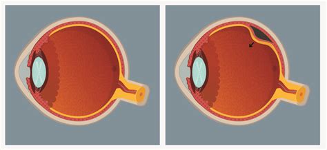 What to Expect During Recovery After a Retinal Detachment