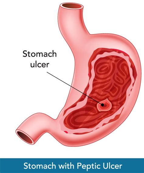 Peptic Ulcer - CVSKL