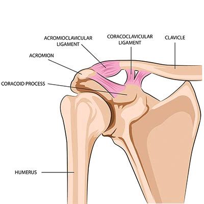 Injured your AC Joint? | Auckland Shoulder Clinic