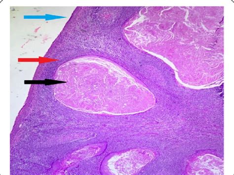 Tonsillar epidermoid cyst on HPE. Black arrow-dilated cysts filled with... | Download Scientific ...