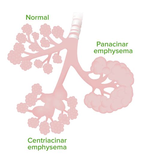 Chronic Obstructive Pulmonary Disease (COPD) | Concise Medical Knowledge