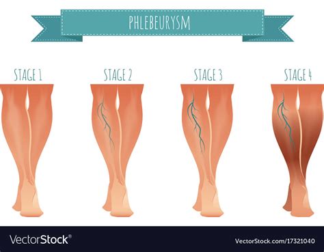 Phlebology infographic treating varicose veins Vector Image