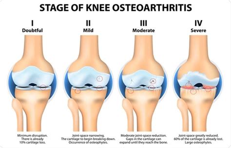 Should You Exercise With Osteoarthritis?