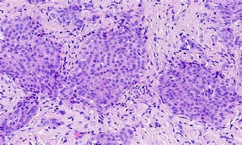 Mesothelioma Histology Psammoma