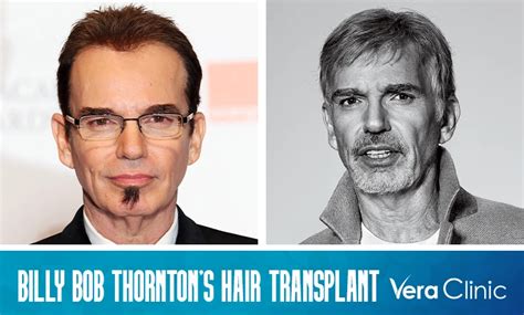 Billy Bob Thornton Hair Transplant: The World of Celebrity Hair Transplants