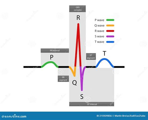 Ecg Waveform, Normal Atrial and Ventricular Depolarization with Electrocardiogram Description ...