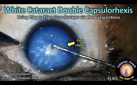 1303: white cataract double capsulorhexis – Cataract Coach™