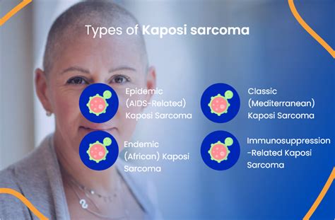 Unraveling Sarcoma Kaposi: A Comprehensive Guide to Understanding and ...