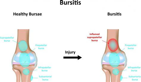 Types of Bursitis Treatment | EmergeOrtho—Triangle Region