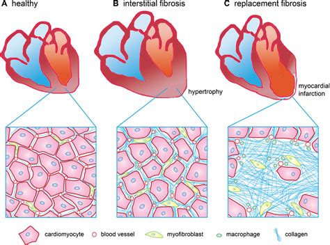 Myocardial fibrosis. a Healthy myocardium consists of a compact... | Download Scientific Diagram