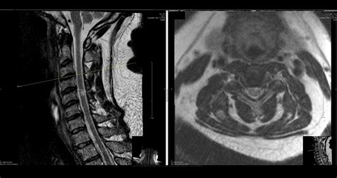 MRI of Herniated Cervical Disc - Dr. Kevin Pauza, The Discseel ...