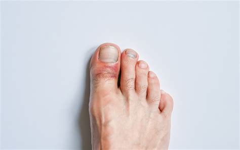 Big Toe Pain From Running? Here Are 7 Possible Causes