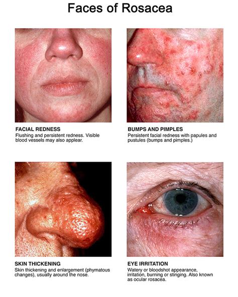 All About Rosacea | Rosacea.org