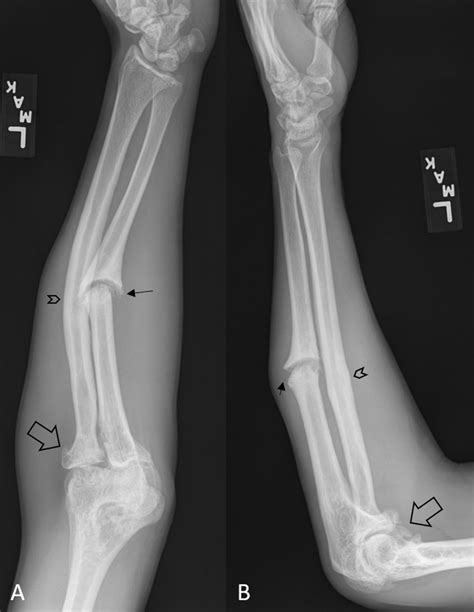 Non-union ulnar fracture as a result of a remote injury | BMJ Case Reports