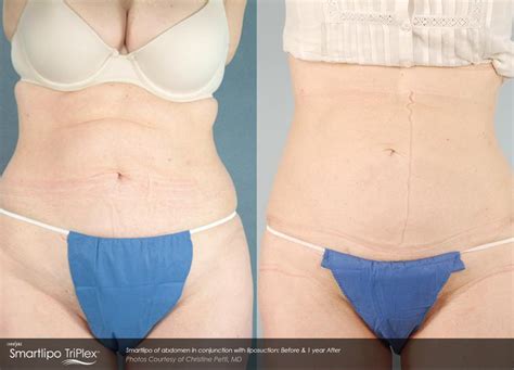 Smartlipo Triplex B&A 09 – Cynosure Portal