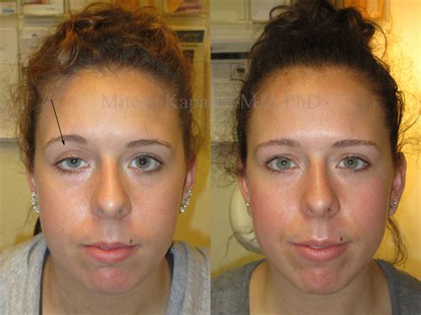 Before and After Ptosis Repair and Eyelid Retraction Surgery Photos - Boston Eyelids
