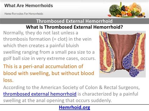 Thrombosed External Hemorrhoid