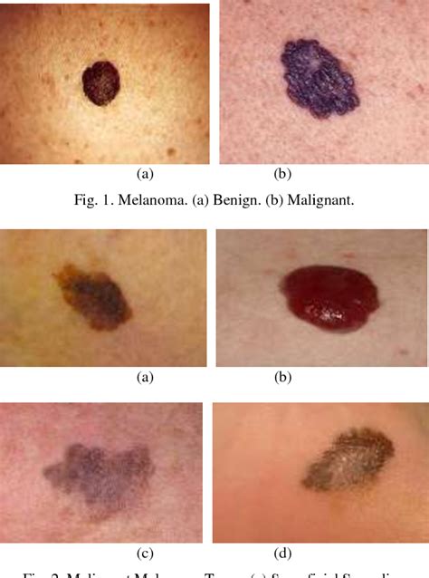 [PDF] Early Detection and Classification of Melanoma Skin Cancer ...