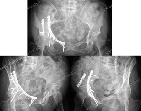 Acetabular Fracture Treatment in Older Patients: Orthopedics