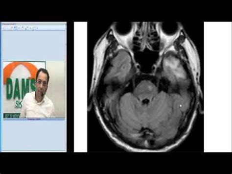 Wallerian Degeneration : MRI - Sumer's Radiology Blog