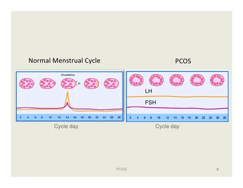 Polycystic Ovarian Syndrome Lh Fsh Ratio - Captions Update Trendy