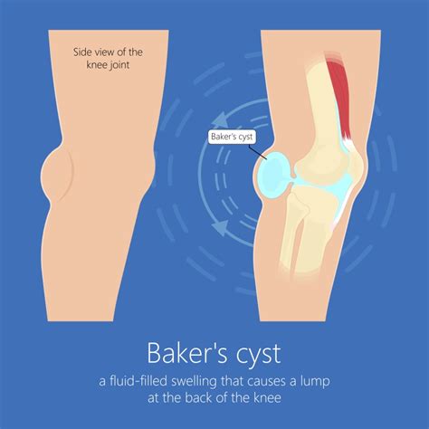 Baker's cyst drainage: is it necessary? - Sport Doctor London